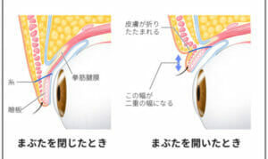 あいなぷぅ二重と歯の矯正